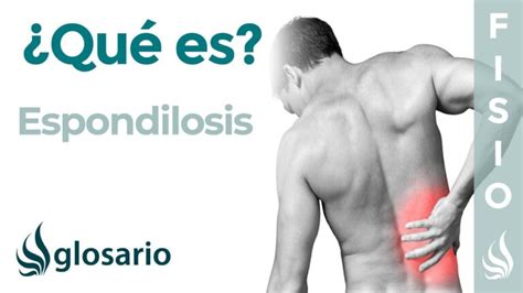 C Mo Se Cura La Espondilosis Lumbar Actualizado Octubre