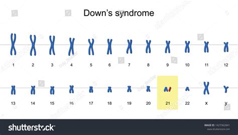 Downs Syndrome Karyotype Autosomal Abnormalities Trisomy Stock Vector Royalty Free 1427362841