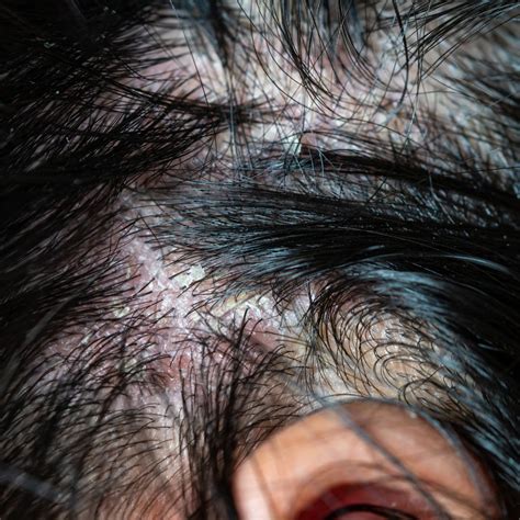 Psoriasis Scalp