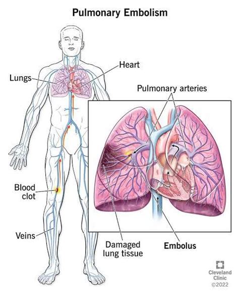 Side Effects Of Treatment Of Pulmonary Embolism Medizzy