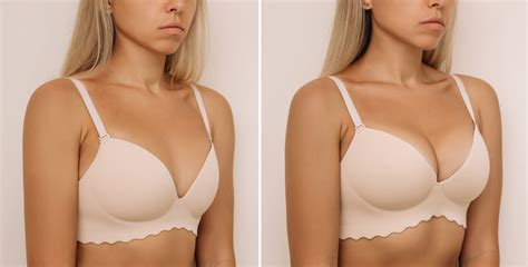 Breast Lift In Pakistan Restoring Youthful And Perky Breasts