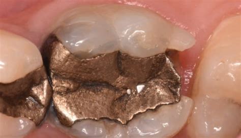 Large Amalgam Replaced With Indirec Lithium Disilicate Overlay For