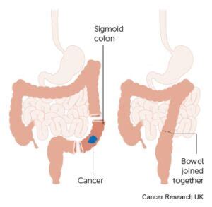 Colectomy The Operative Review Of Surgery