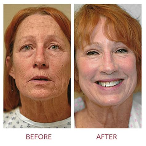 Laser Skin Resurfacing Palm Springs Co2 Laser Face Resurfacing Rancho