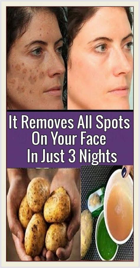 This 2 Ingredient Remedy Removes Brown Spots On Hands Brown Spots On Face Spots On Face