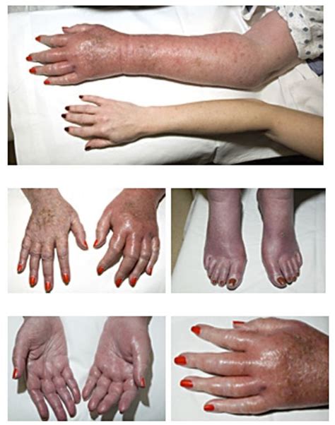 Polycythemia Vera Wikem