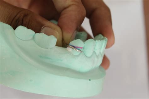 Step By Step Guide For Understanding The Prosthodontics Making Clasp For Acrylic Partial Denture