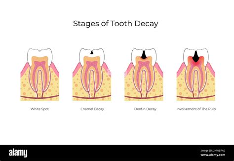 Etapas De La Caries Dental Ilustración Fotografía De Stock Alamy