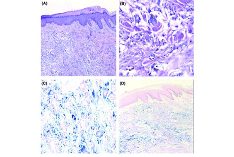 Histopathological Examination A B Interlacing Fascicles Of Spindle