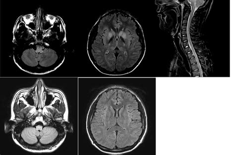 Figure. Brain MRI and spine MRI of the patient on 6 days after onset of ...