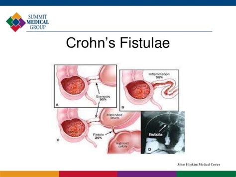 Inflammatory Bowel Disease Ibd