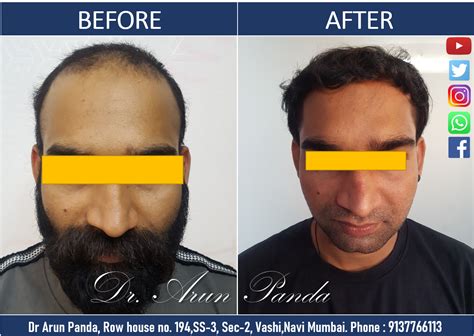 Best Hair Transplant In Navi Mumbai Dr Arun Panda