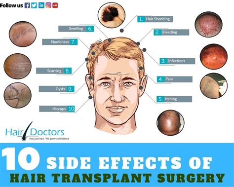 10 Side Effects Of Hair Transplant Surgery Hair Transplant Hair Transplant Surgery Hair Loss