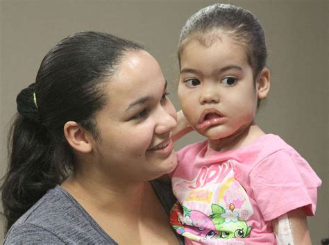 Surgeons Remove 5 Pound Facial Tumor From 3 Year Old Brazilian Girl