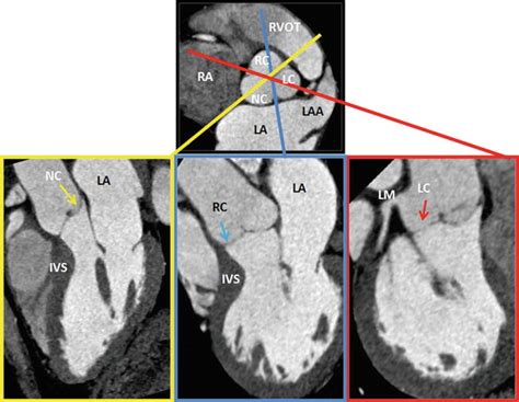 Left Ventricular Outflow Tract | Radiology Key