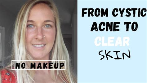 Pcos How I Healed My Cystic Acne For Good Youtube