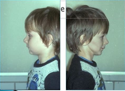 Developmental And Acquired Abnormalities With Images Part Ii Flashcards