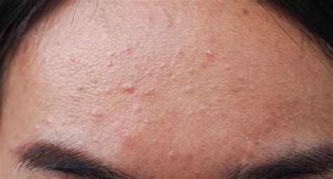 How To Get Rid Of Fungal Acne Heres What You Should Know