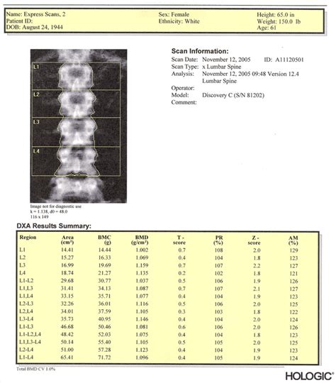 Hologic Bone Density Report Sample