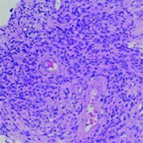 Histologic Examination H E At Low Power Show Neoplastic Cells