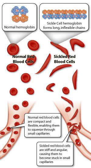 Sickle Cell Anemia - Home