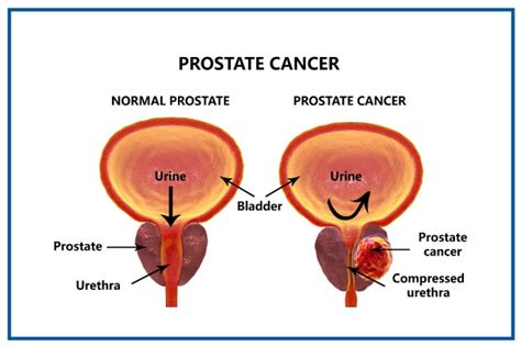 Prostate Cancer: Symptoms, Causes, Diagnosis & Treatment