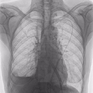 Chest Radiograph Postero Anterior View Of Fourth Case Demonstrating A