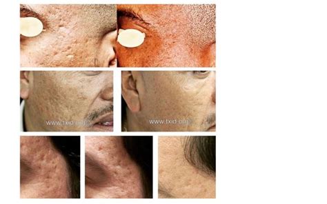 Iclear A Revolutionary Laser System For Treating Acne Scars By Texas