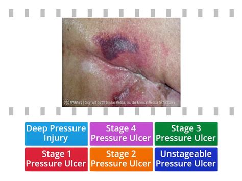 Pressure Ulcer Pictures Cada Oveja Con Su Pareja