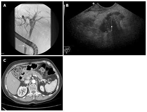 Comparative Analysis Of Ercp Idus Eus And Ct In Predicting Malignant Bile Duct Strictures