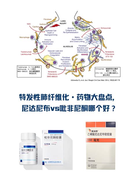 特发性肺纤维化（ipf）指南解读【2】 知乎