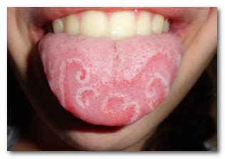 Geographic Tongue Causes Pictures Symptoms Treatment