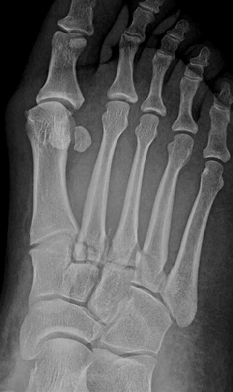 Image Lisfranc Fractures Msd Manual Professional Edition