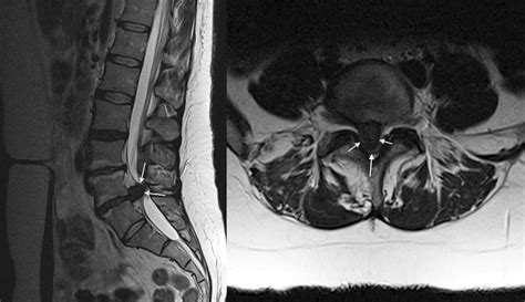 Cauda equina compression - Radiology at St. Vincent's University Hospital