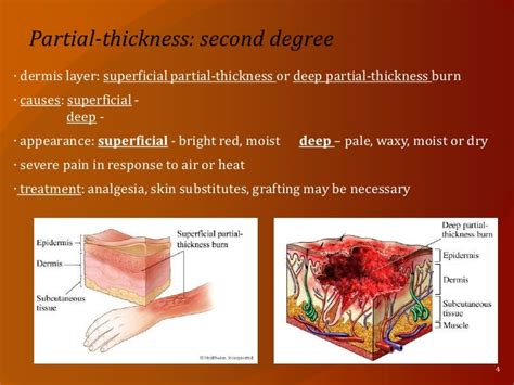 Nurs202 Burn Injuries Final