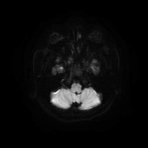 Area Postrema Syndrome Image