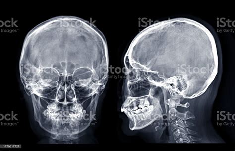 Paranasal sinuses + mastoid air cells (X-Ray) Diagram | Quizlet