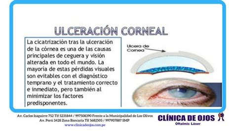 Cl Nica De Ojos Oftalmic L Ser Ulceraci N Corneal