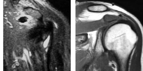 A Sinovitis Vellonodular Pigmentada Tipo Focal En El Hombro En La