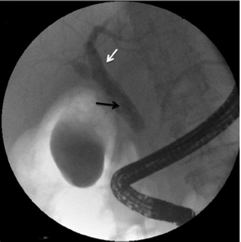 Ercp Has Showed Dilatation Of Common Bile Duct White Arrow With Download Scientific Diagram