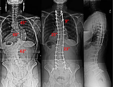 Adult Spinal Deformity Treatment Surgery Therapy NJ NYC