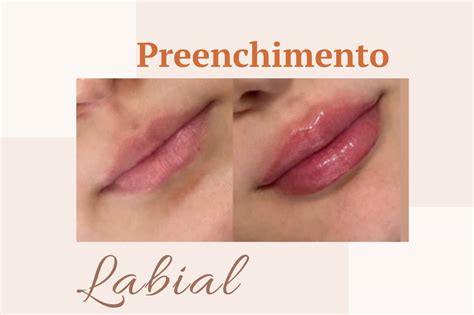 Preenchimento Labial Guia Saúde Cidades