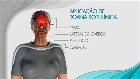 Bem Estar Tratamentos Toxina Botul Nica E Neuromoduladores Ajudam