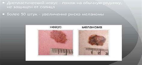 Ожог солнца. Опасные родинки почему появляются родинки — yznaemtut.ru