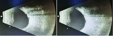 B Scan Ultrasound Of Each Eye Showing A Single Optic Nerve Shadow A