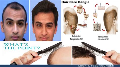 Hair Transplant Process Fue And Fut Explain About Side Effects Surgery Cost Before And