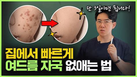 색소침착 피부과 안 가도 됩니다 직접 효과 본 집에서 여드름 자국 없애는 법 Youtube