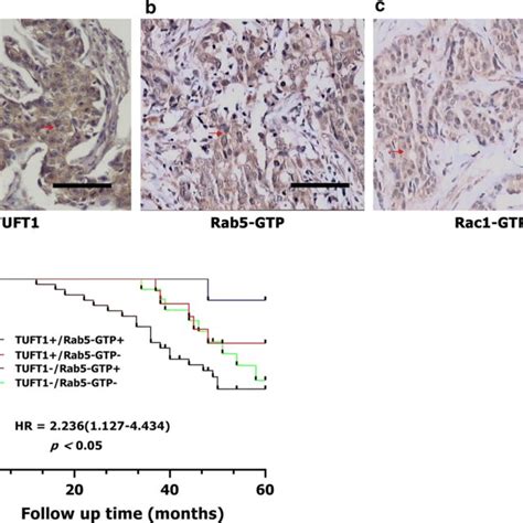 The Expression Of TUFT1 Rab5 GTP And Rac1 GTP In 80 TNBC Patients Who