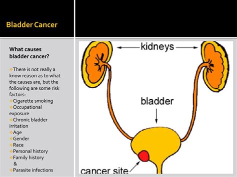 Ppt Bladder Cancer Powerpoint Presentation Free Download Id3444421