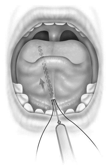 Tongue Suspension Suture In Obstructive Sleep Apnea Operative